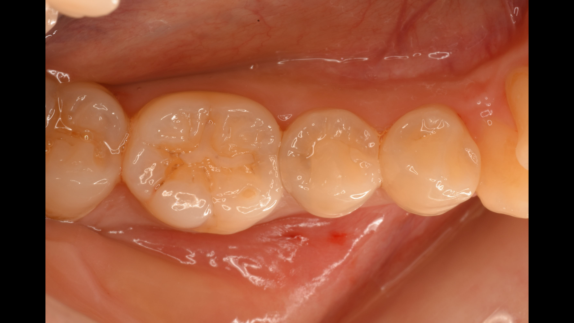 歯 と 歯 の 間 虫歯 初期